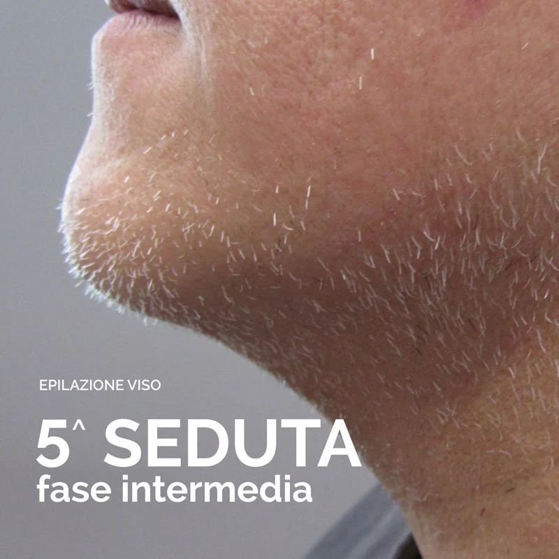 Epilazione Laser Bergamo